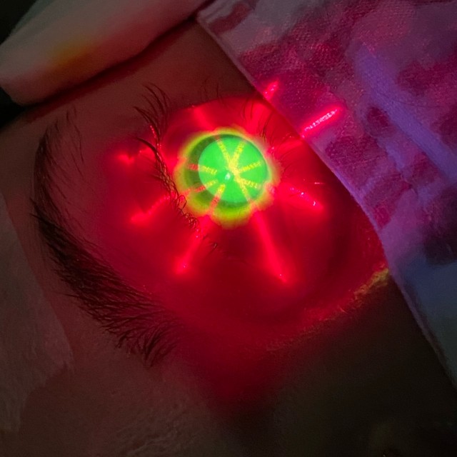 (Corneal Cross-Linking, Dr. James Reidy) 
